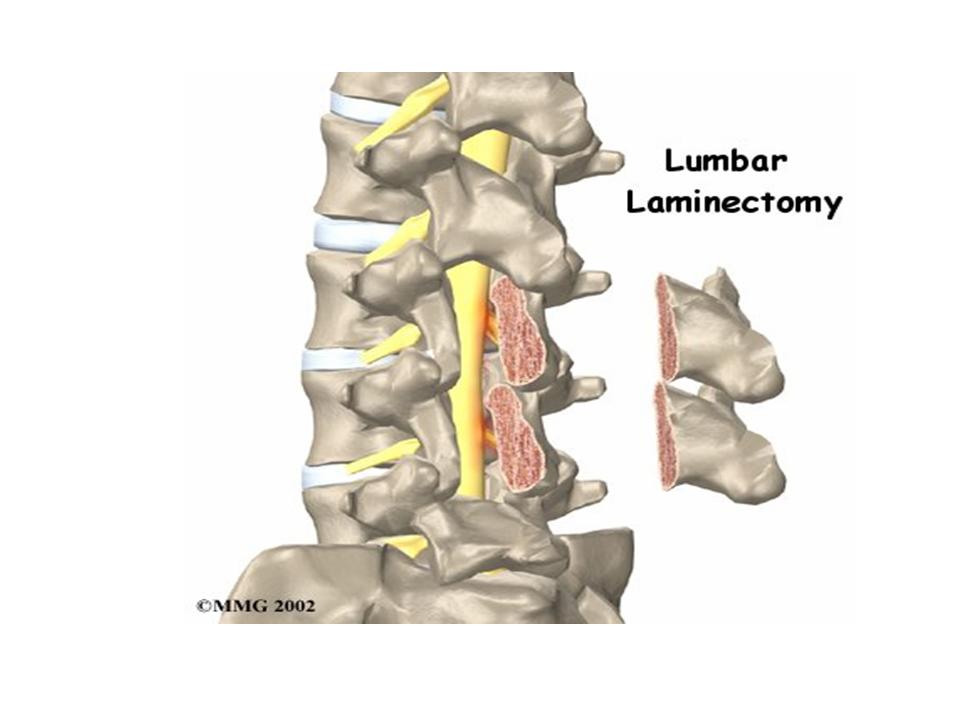 Sex after lsh hysterectomy