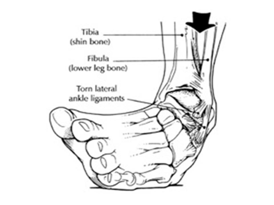 Ankle sprain Jun Xu, M.D. (203) 6377720, 1171 E Putnam Ave
