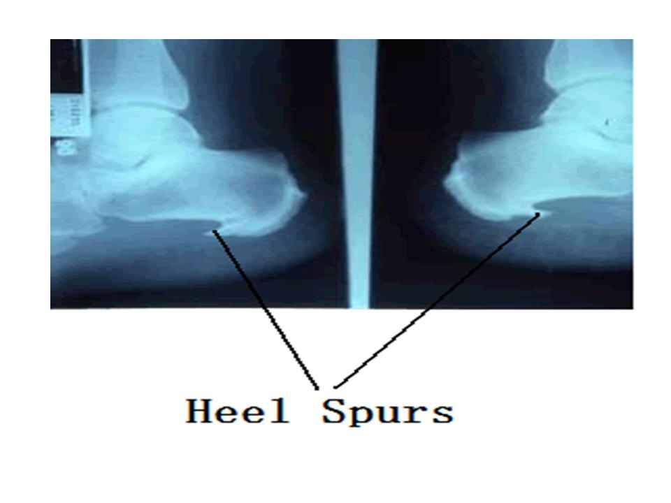 Heel Spur Jun Xu, M.D. (203) 6377720, 1171 E Putnam Ave, Greenwich