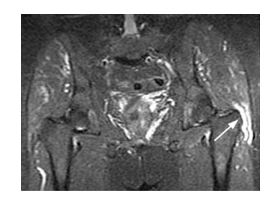 hip bursitis acupuncture treatment Jun Xu, M.D. (203) 6377720, 1171