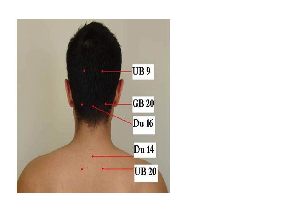 37. Acupuncture and Intorable Headache « Jun Xu, M.D. (203) 6377720, 1171 E Putnam Ave