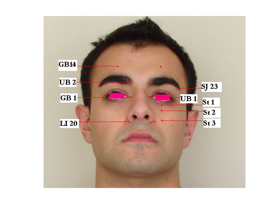 62. Acupuncture is the best to treat allergy and sinusitis Jun Xu, M.D. (203) 6377720, 1171 E