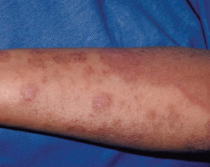 Pic 3 Atopic eczema