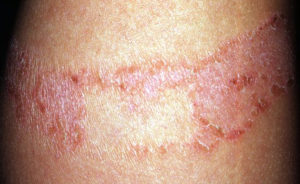 Pic 5 allergic contact eczema