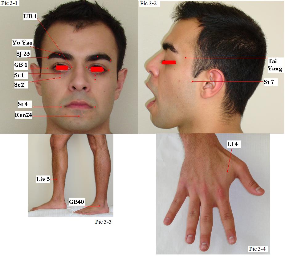 14 Acupuncture and Trigeminal Neuralgia Jun Xu, M.D. R.M.A.C