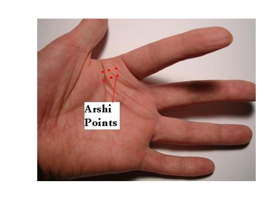 21. Acupuncture and Trigger FingerDont’ Text Message Too Much Jun Xu