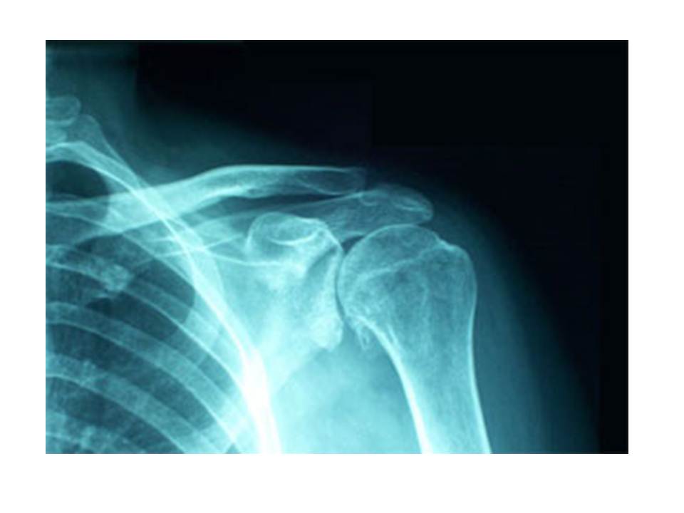 38. Acupuncture and Shoulder Arthritis Jun Xu, M.D. R.M.A.C