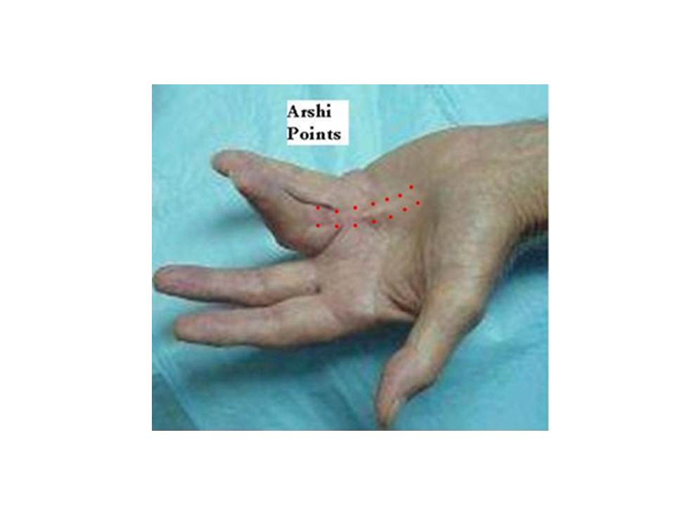 40. Acupuncture and Dupuytren’s Contracture Jun Xu, M.D. R.M.A.C