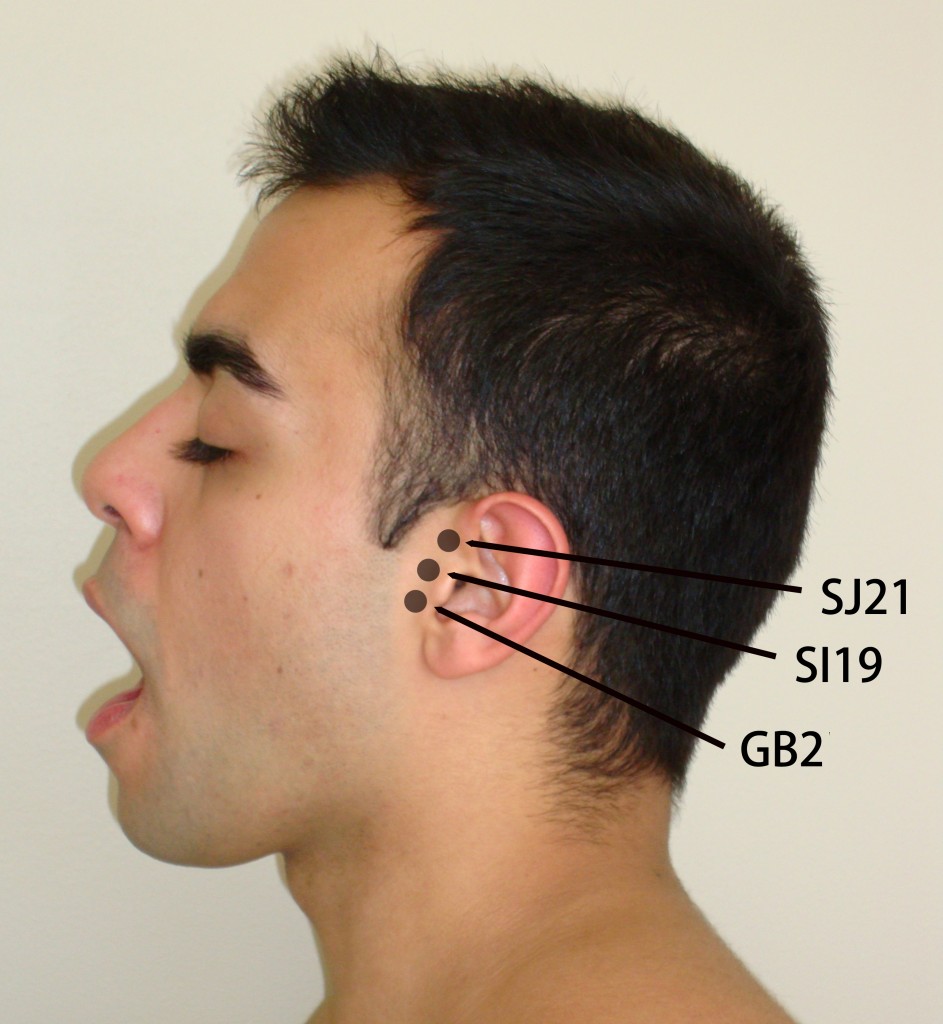 47. Acupuncture and Tinnitus Jun Xu, M.D. R.M.A.C, Greenwich, CT
