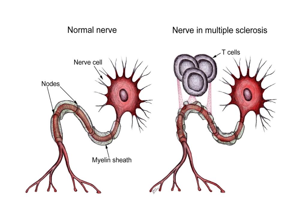 48. Acupuncture and Multiple Sclerosis Jun Xu, M.D. R.M.A.C