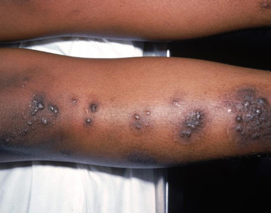 65. Eczema and Acupuncture Treatment | Jun Xu, M.D. R.M.A.C, Greenwich, CT