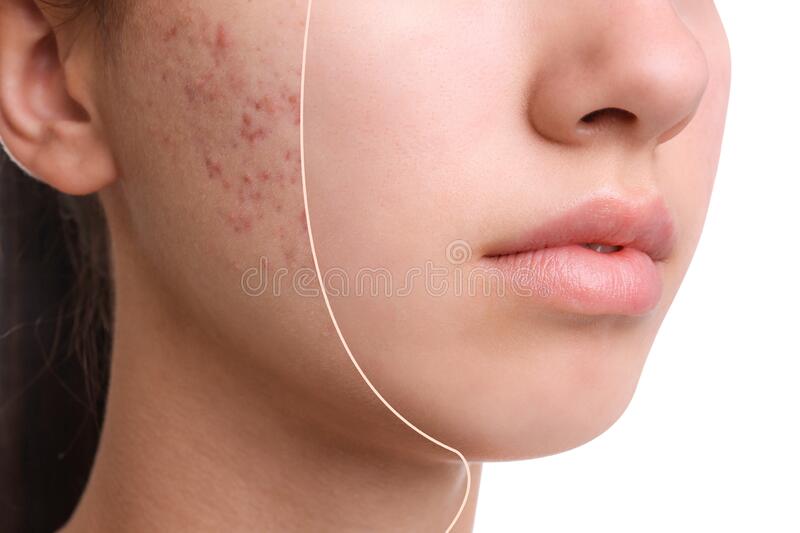 https://www.drxuacupuncture.co/wp-content/uploads/2022/04/teenage-girl-acne-treatment-background-closeup-teenage-girl-acne-treatment-white-170106914.jpg